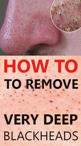 How To Remove Very Deep Blackheads With Vaseline Artofit