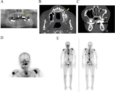 Figure 2 From Denosumab Related Osteonecrosis Of The Jaw In A Patient