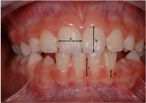 Gingival Biotype Assessement Visual Inspection Relevance And Maxillary Versus Mandibular