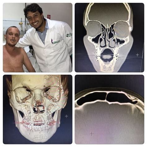 Redução Incruenta Clínica Face Implantes