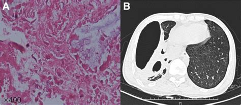 A Case Report Of Community Acquired Pseudomonas Aeruginosa Pneumonia