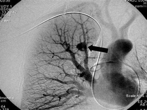 Hipertensión Pulmonar Y Esclerosis Vascular Ppt