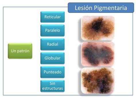 Dermatoscopia En Lesiones Pigmentarias PPT