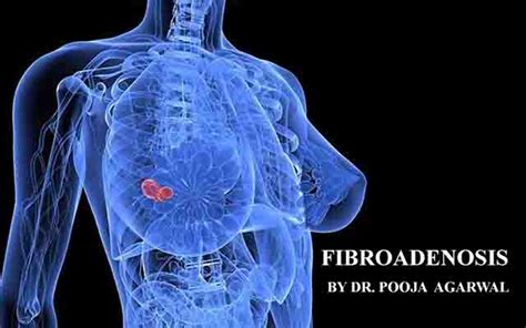 Causes And Symptoms Of Fibroadenosis Or Fibrocystic Disease Dr Pooja