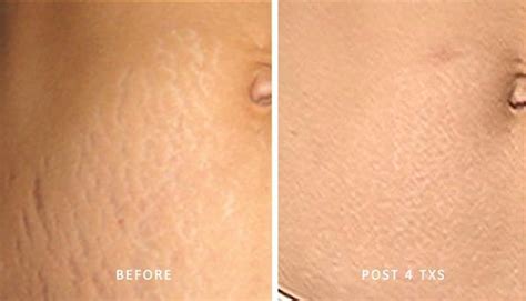 Can Stretch Marks Be Removed With Laser Orange Coast Aesthetics