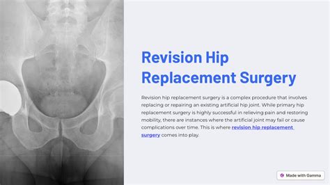 Ppt Revision Hip Replacement Surgery Powerpoint Presentation Free Download Id 13265477