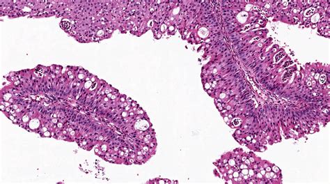 Inverted Nasal Papilloma