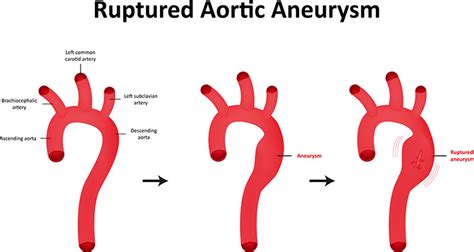 New York Thoracic Aortic Aneurysm, Treatment for Chest Aneurysms | NYC