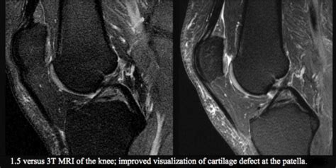 Osteoarthritis Of The Knee Hip And Back Pain UCSF Radiology