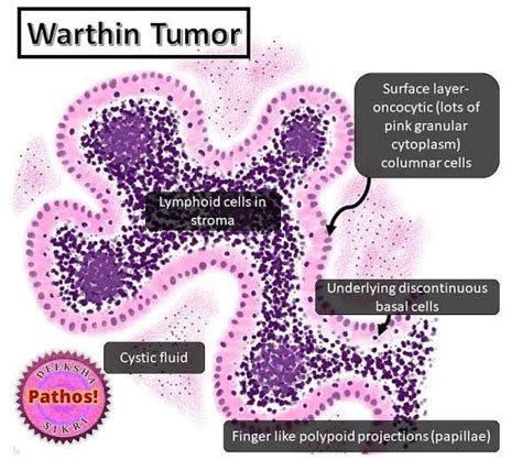 Warthin Tumor MEDizzy