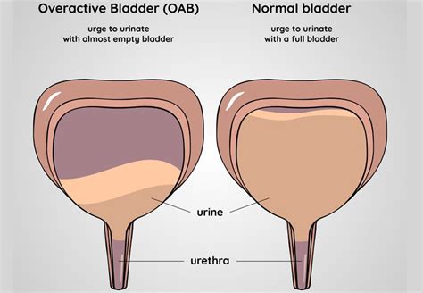 6 Means To Treat Bladder Leakage