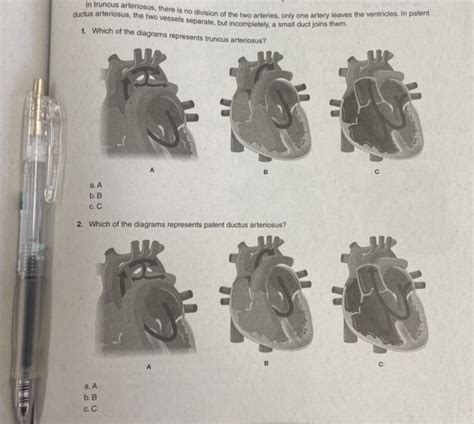 In Truncus Arteriosus There Is No Division Of The Two Arteries Only One