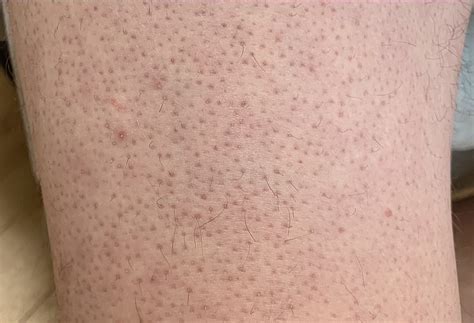 Keratosis pilaris - Wikipedia