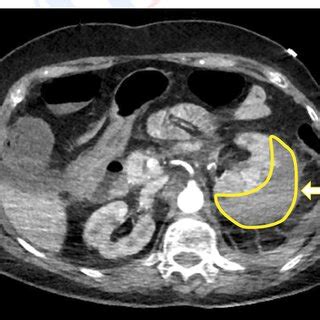 Abdominal Computed Tomography Sagittal Plane Revealing Extensive