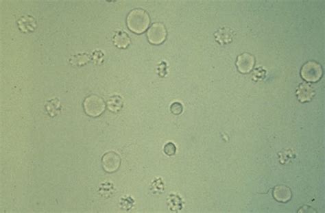 Urinalysis Crystals From Test 1 Flashcards Quizlet