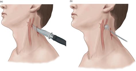Penetrating Neck Injuries - REBEL EM - Emergency Medicine Blog