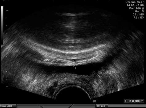 Inter‐ And Intraobserver Variability In Sonographic Measurement Of The