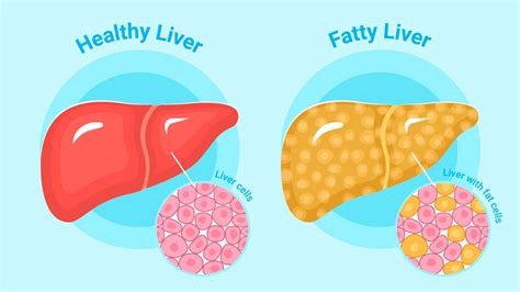 Fatty Liver Dietary Modifications