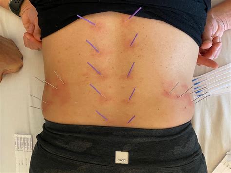 Pelvic Floor Dry Needling To Reduce Stress Anxiety Pain Associated