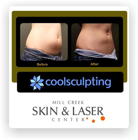 Coolsculpting Procedure Freezes Away Fat