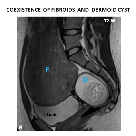 Ovarian Fibroma Simulating Pedunculated Subserosal Fibroid In A