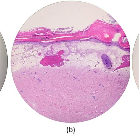 A Histologic Sections Demonstrate A Squared Off Biopsy Specimen B