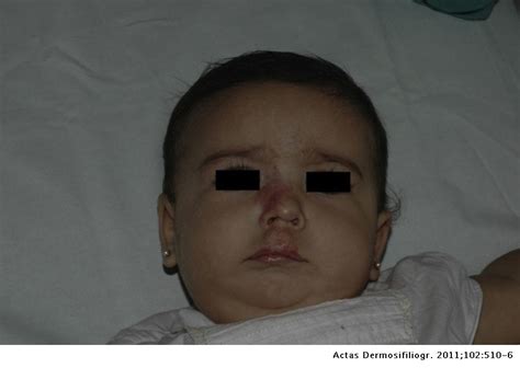 Propranolol For The Treatment Of Severe Hemangiomas Of Infancy Results