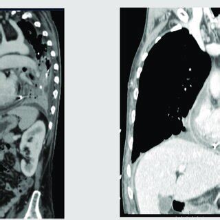 Sagittal View Collection In The Anterior Mediastinum Pre Cardiac