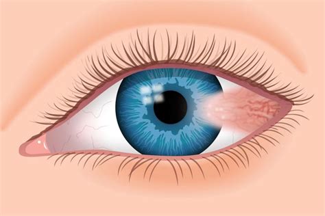 Pterygium Removal Surgery - Eagle Eye Centre