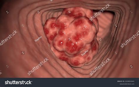 3d Rendered Medical Illustration Colon Cancer Stock Illustration