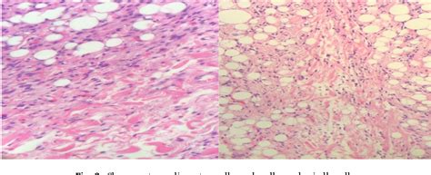 Figure 2 From A Case Report Of Spindle Cell Lipoma Semantic Scholar