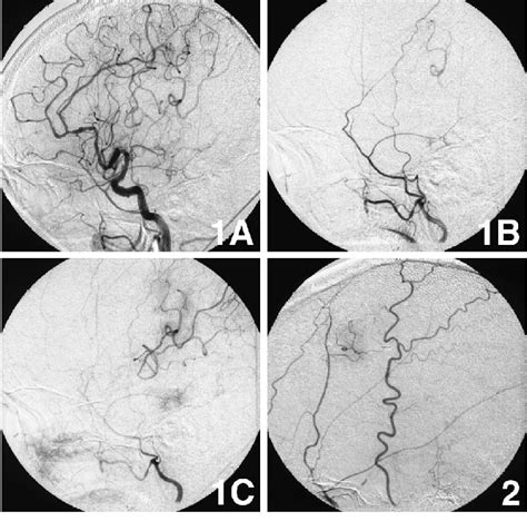 Case 1 A Left Common Carotid Angiogram Showing Stenosis Of The Left