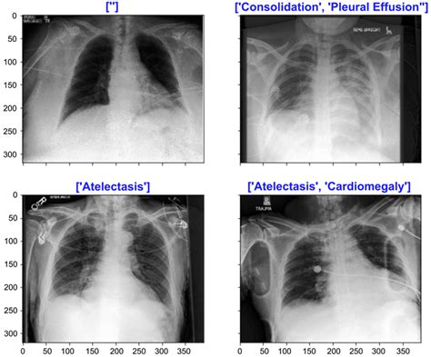 Multi Label Chest X Ray Classification Via Deep Learning