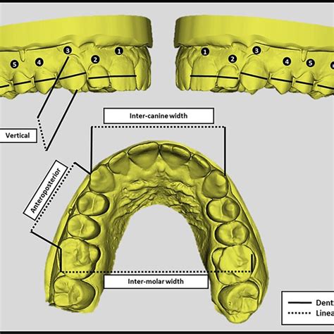 Measurements Made On The Digital Cast Models Maxillary Arch