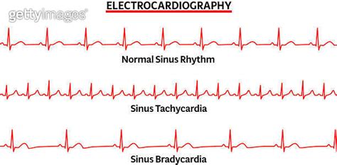 Set Of Ecg Common Abnormalities Normal Sinus Rhythm Sinus