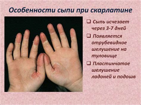 Сестринская помощь при скарлатине и коклюше - презентация онлайн
