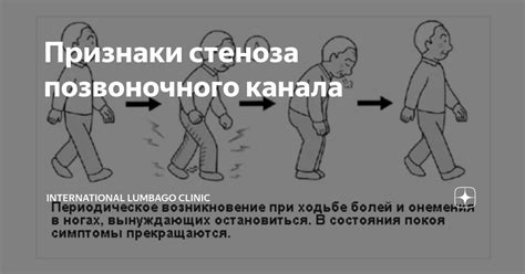 Признаки стеноза позвоночного канала | International Lumbago Clinic | Дзен