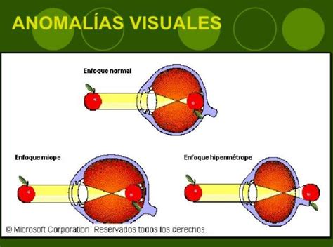 Anomalías De La Visión Síntomas Y Recomendaciones