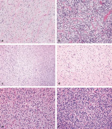 Kinase Rearranged Fibroblastic Tumors A B Bland Hypocellular Tumors