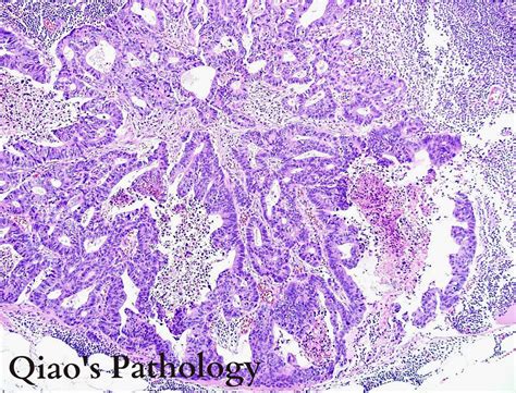 Qiao S Pathology Adenocarcinoma Of The Colon With Lymph Node Metastasis A Photo On Flickriver