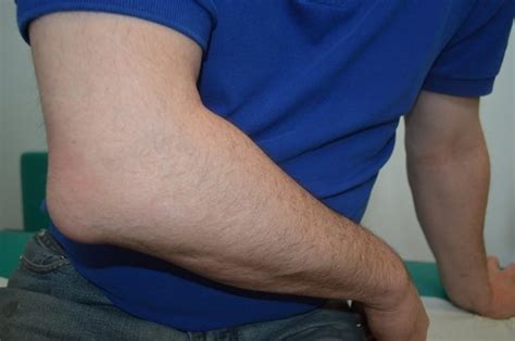 Bursitis De Codo Sin Dolor Causas Tratamiento Natural Y Remedios