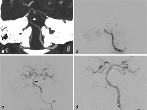 Endovascular Treatment Outcome And Ct Angiography Findings In Acute