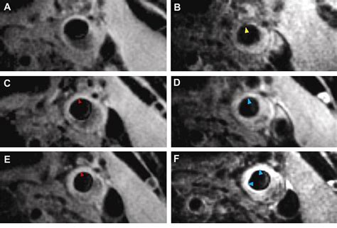 Figure 2 From Noninvasive Carotid Artery Imaging With A Focus On The