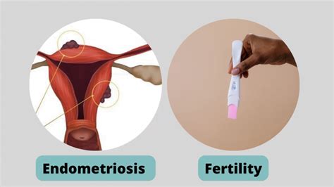 Endometriosis Fertility Solutions Sahyadri Hospital