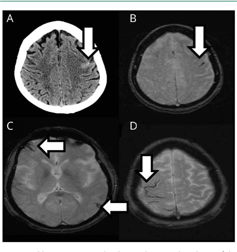 Figure 1 From Cerebral Amyloid Angiopathyrelated Transient Focal