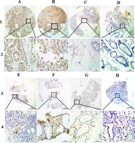 Representative Images Of Trop Protein Expression In Gastric Tissue Tma