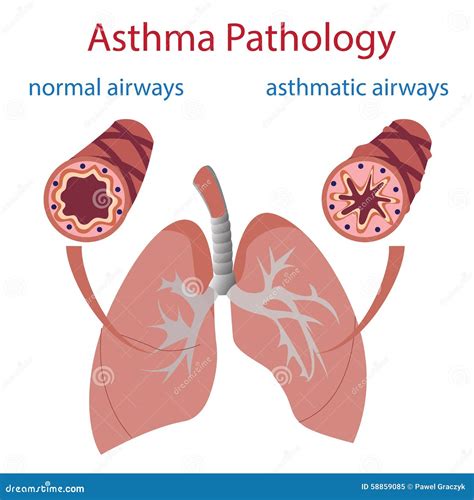 Asthma Pathology Stock Vector Image 58859085