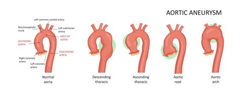 Aortic Root Dilation