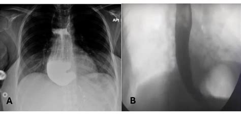 Robotic Heller Myotomy For Advancements In Surgical Management Of