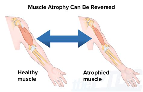 How To Fight Muscle Atrophy After Injury A Personal Trainers Guide